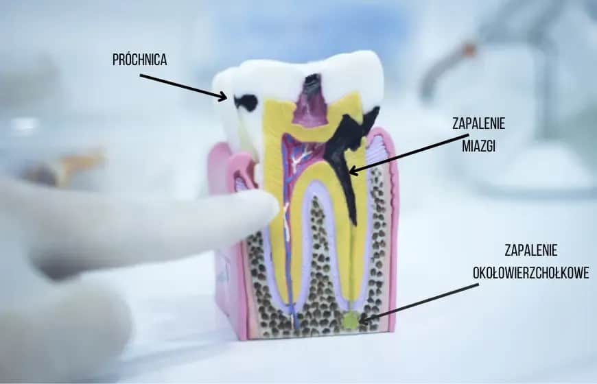 Ból zęba: Rozpoznaj objawy i działaj! Poradnik Kajetana Kaczmarka