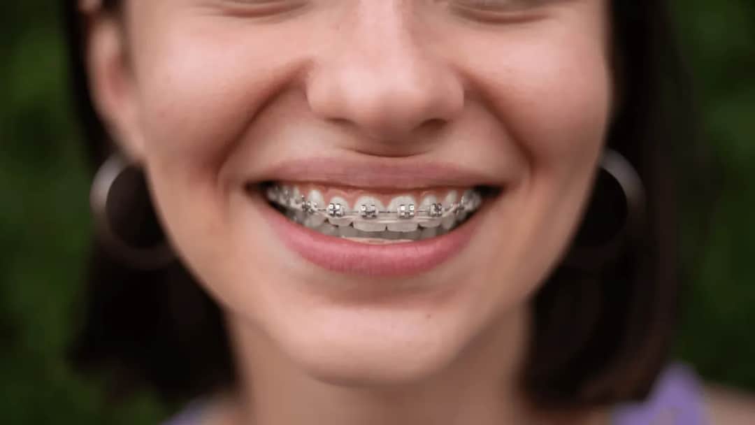 Aparaty na zęby: jak wyglądają? Odkryj dyskretne opcje!