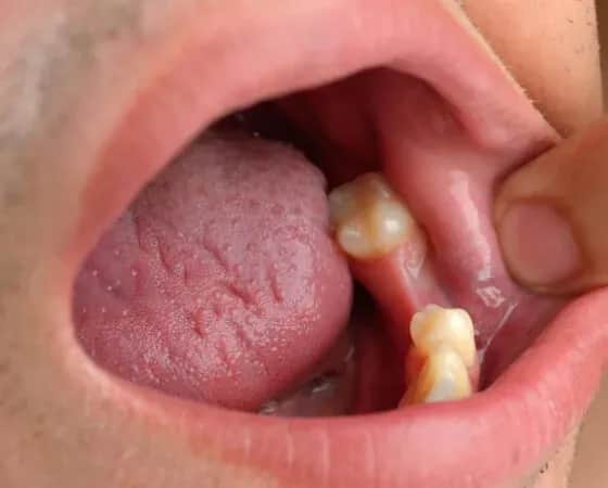 Biały nalot po wyrwaniu zęba: włóknik czy suchy zębodół?