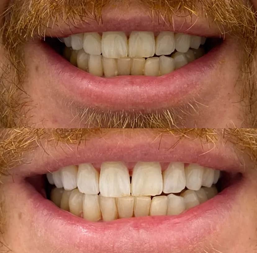 Wybielanie zębów u dentysty: efekty, koszty czy warto?