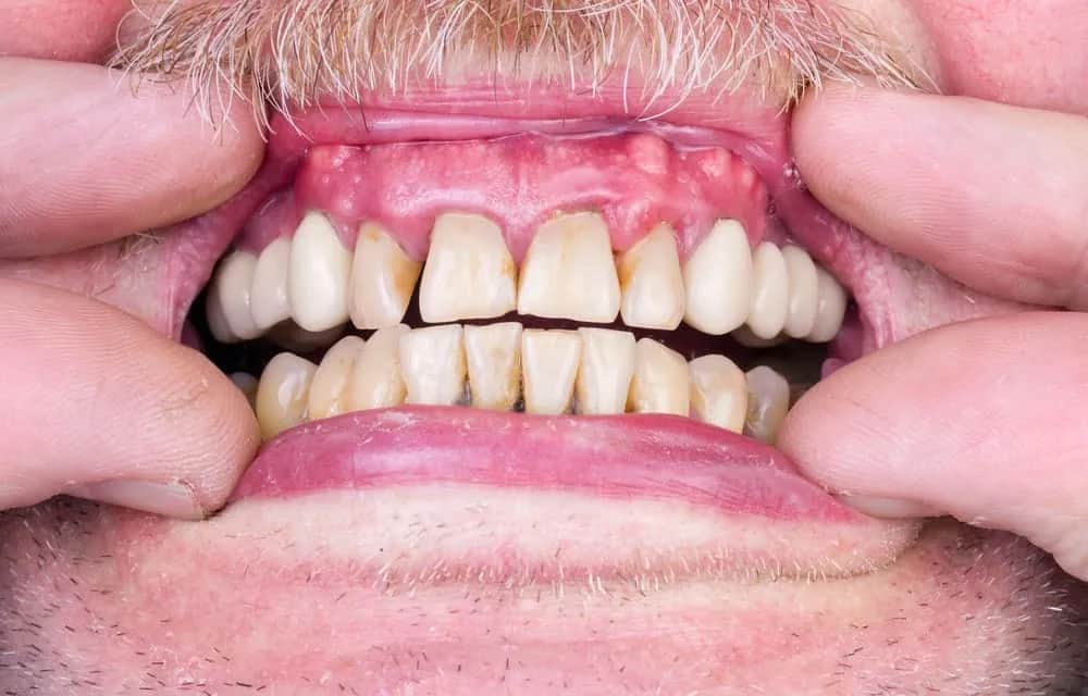 Opuchnięte dziąsła: Przyczyny, objawy i kiedy iść do dentysty?