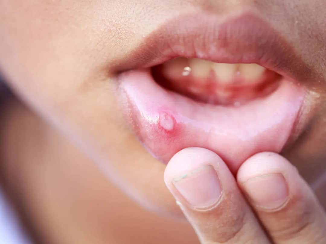 Opryszczkowe zapalenie jamy ustnej: objawy, leczenie i szybka ulga