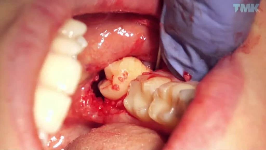 Ból po wyrwaniu zęba? Szybkie gojenie dziąsła i co na suchy zębodół