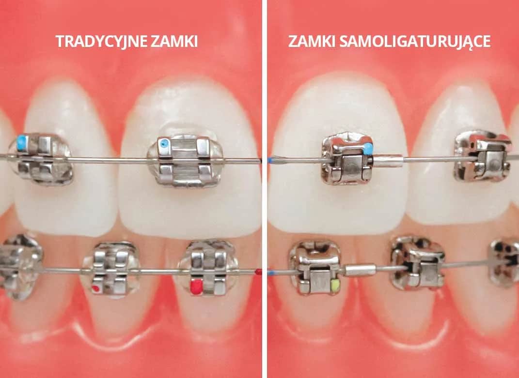 Ile trwa leczenie ortodontyczne? Prawda o czasie noszenia aparatu!