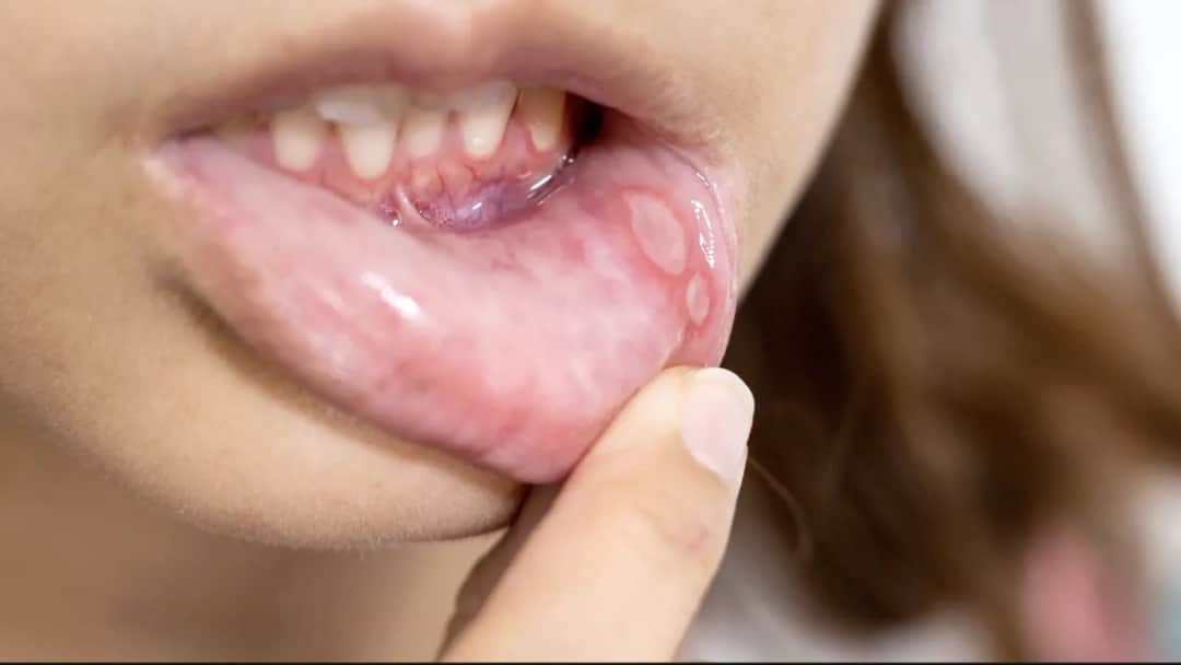 Bolesne afty? Natychmiastowa ulga i skuteczne leczenie!