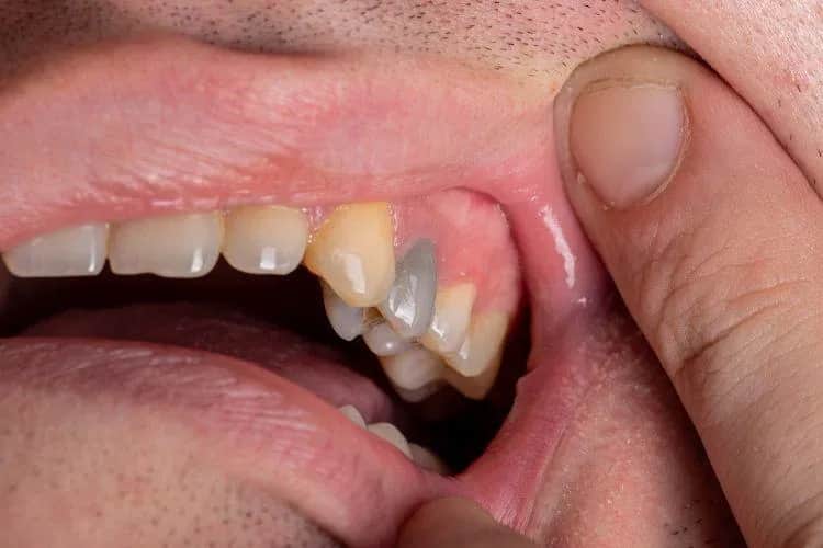 Martwy ząb: Czy wypadnie? Jak go uratować i zachować na lata?