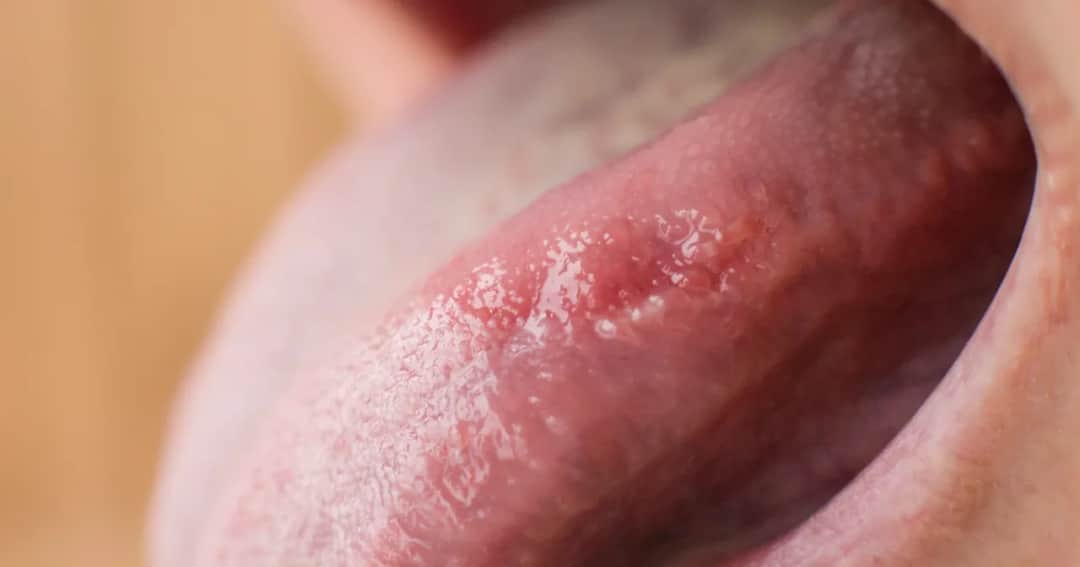 Wczesne objawy raka dna jamy ustnej: Sprawdź, co musisz wiedzieć