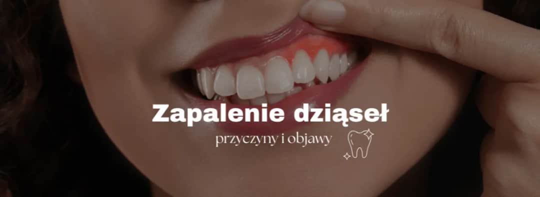 Zapalenie dziąseł: Rozpoznaj objawy i uniknij utraty zębów!
