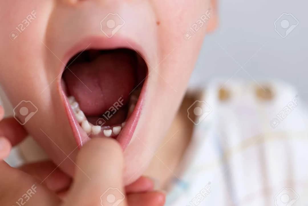 Zęby rekina u dziecka: kiedy działać, a kiedy obserwować?