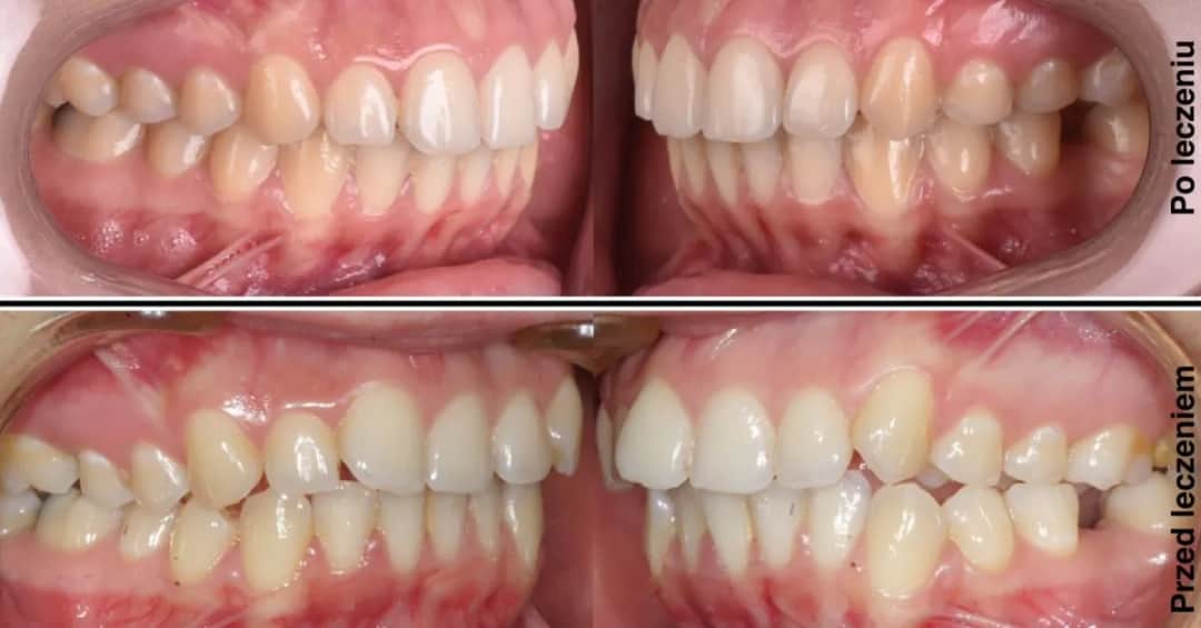 Czy aparat ortodontyczny zmieni Twoją twarz? Rozwiewamy mity!