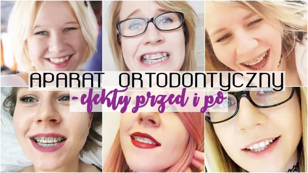Aparat ortodontyczny a usta: Iluzja czy realna zmiana?