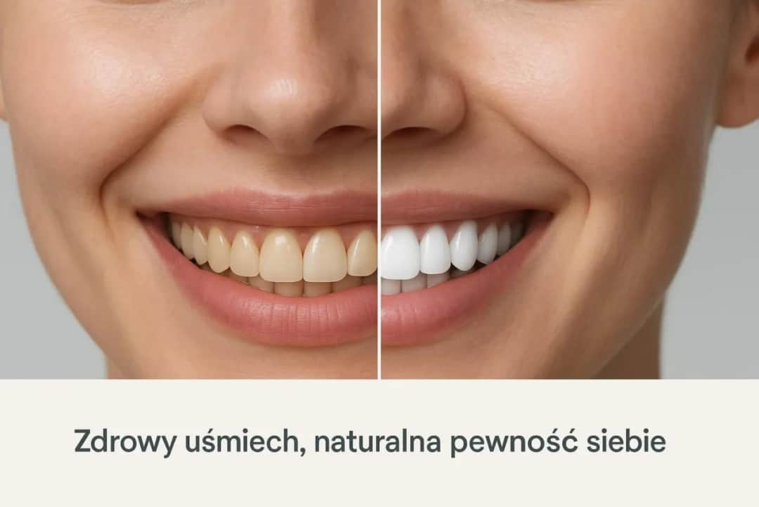 Bezpieczne wybielanie zębów: Jak często, by nie zniszczyć szkliwa?