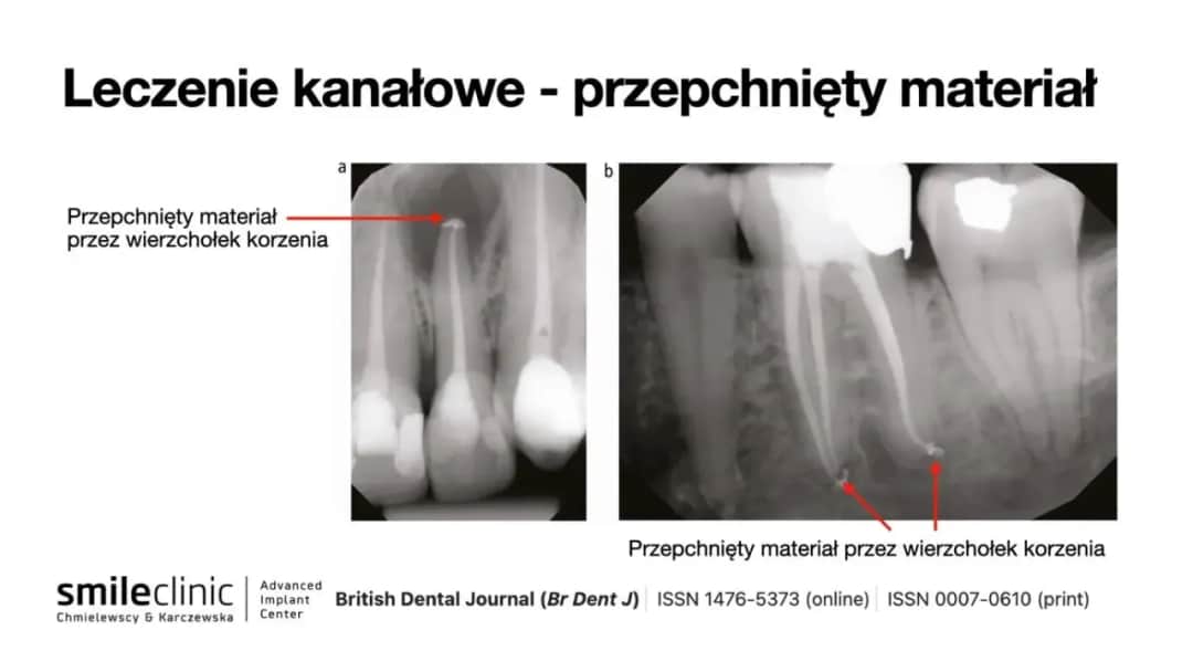 Ból po leczeniu kanałowym: normalny czy alarm? Oś czasu gojenia